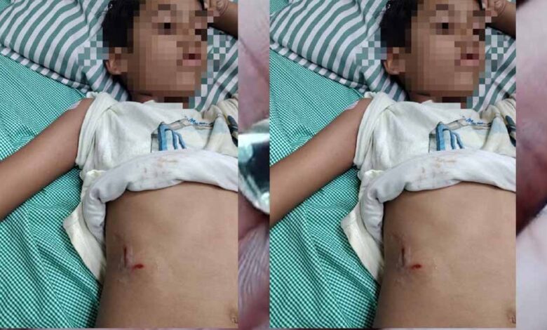 पेबल बे फेस 1, बागमुगलिया कटारा हिल्स में आवारा कुत्ते ने बच्चे को काटा