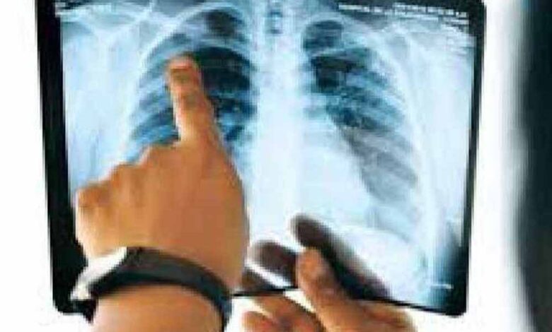 मध्य-प्रदेश-में-‘मेलिओइडोसिस’-का-खतरा-बढ़ा,-लक्षणों-से-डॉक्टर-भी-हो-रहे-भ्रमित